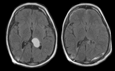 NICO Primary Brain Tumor Scan BrainPath Approach