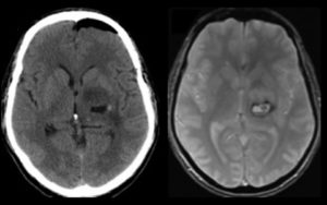 BrainPath Approach for Cerebral Cavernous Malformations (CCMs)