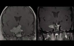 Tumors and Cysts via Transnasal Approach